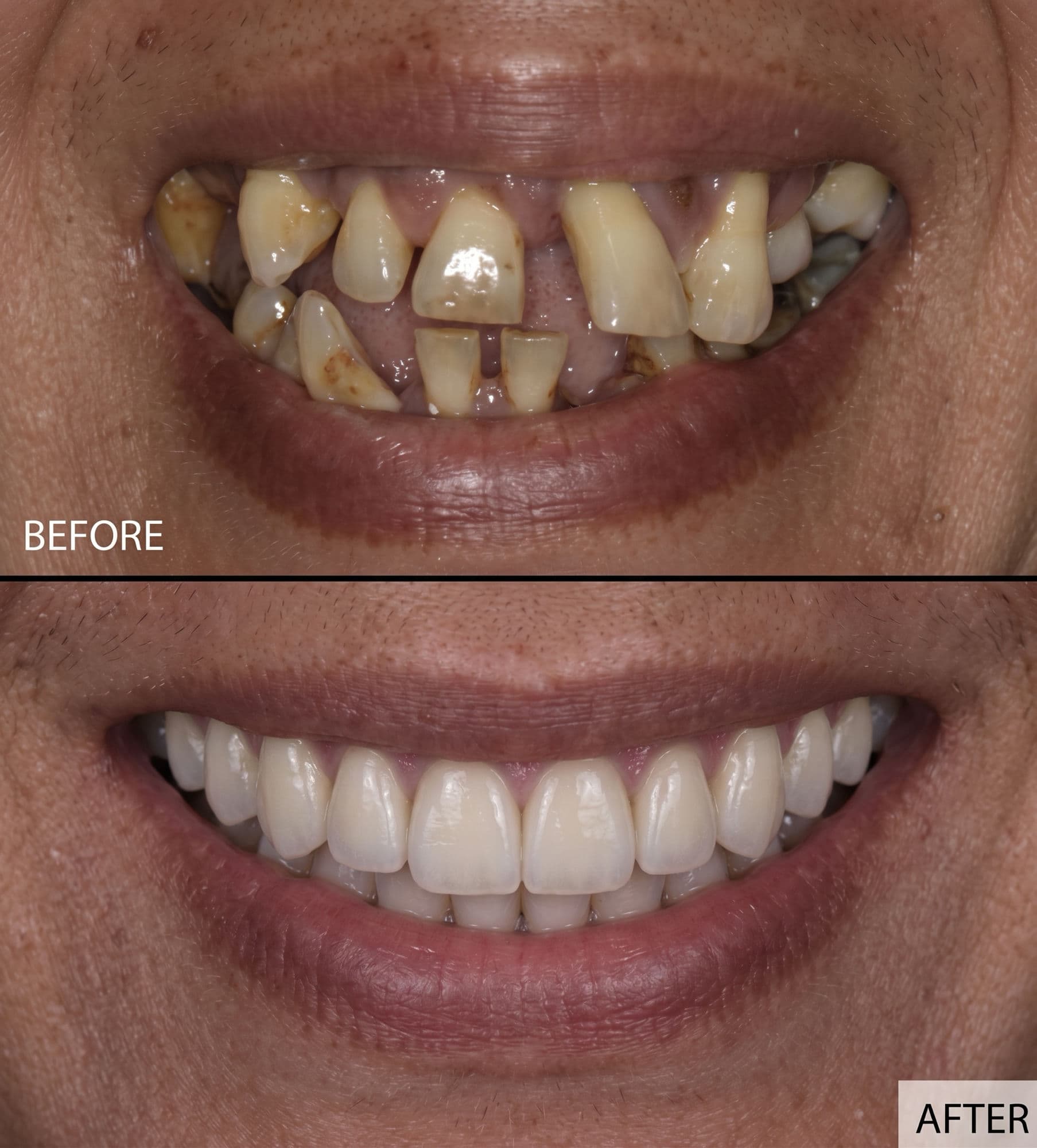 Before and after: a full, confident smile — dental implant treatment at Willow Family Dentistry