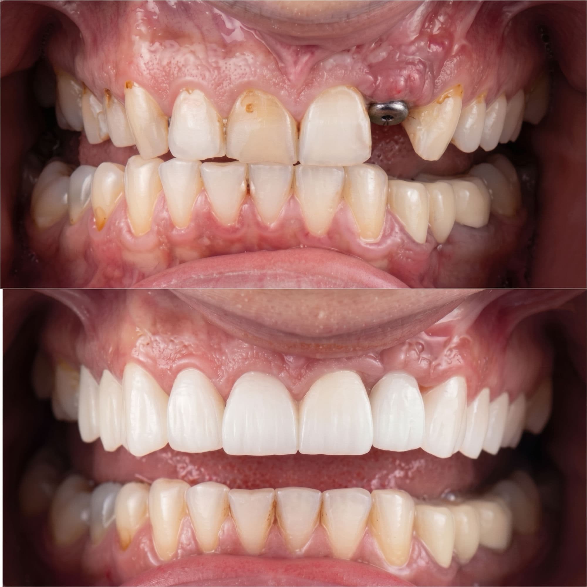 Before and after: a more involved case, solved — dental implant treatment at Willow Family Dentistry