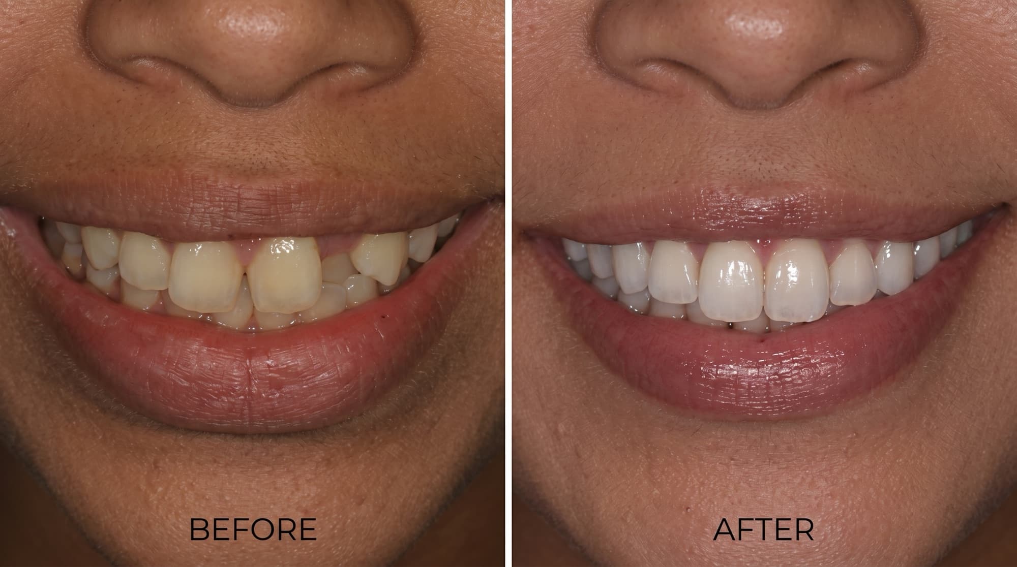 Before and after: full smile makeover — clear aligner treatment at Willow Family Dentistry