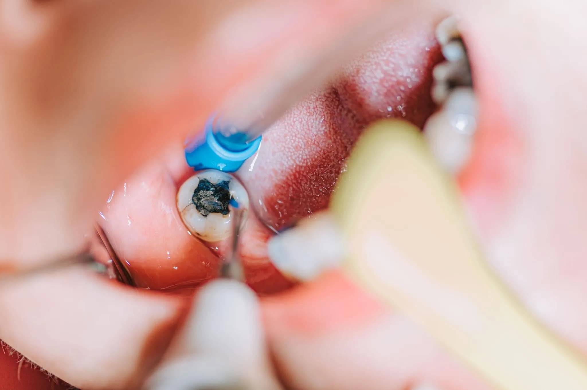 Dental Fillings