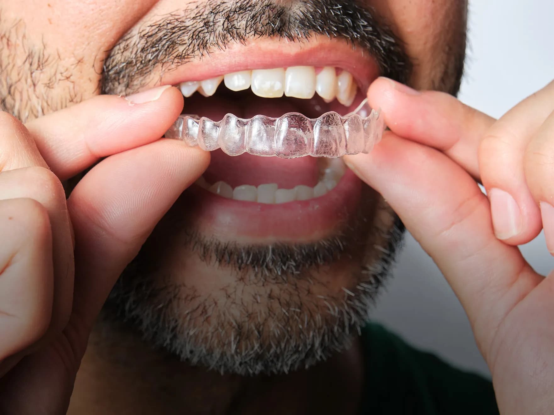 Clear aligner treatment at Willow Family Dentistry