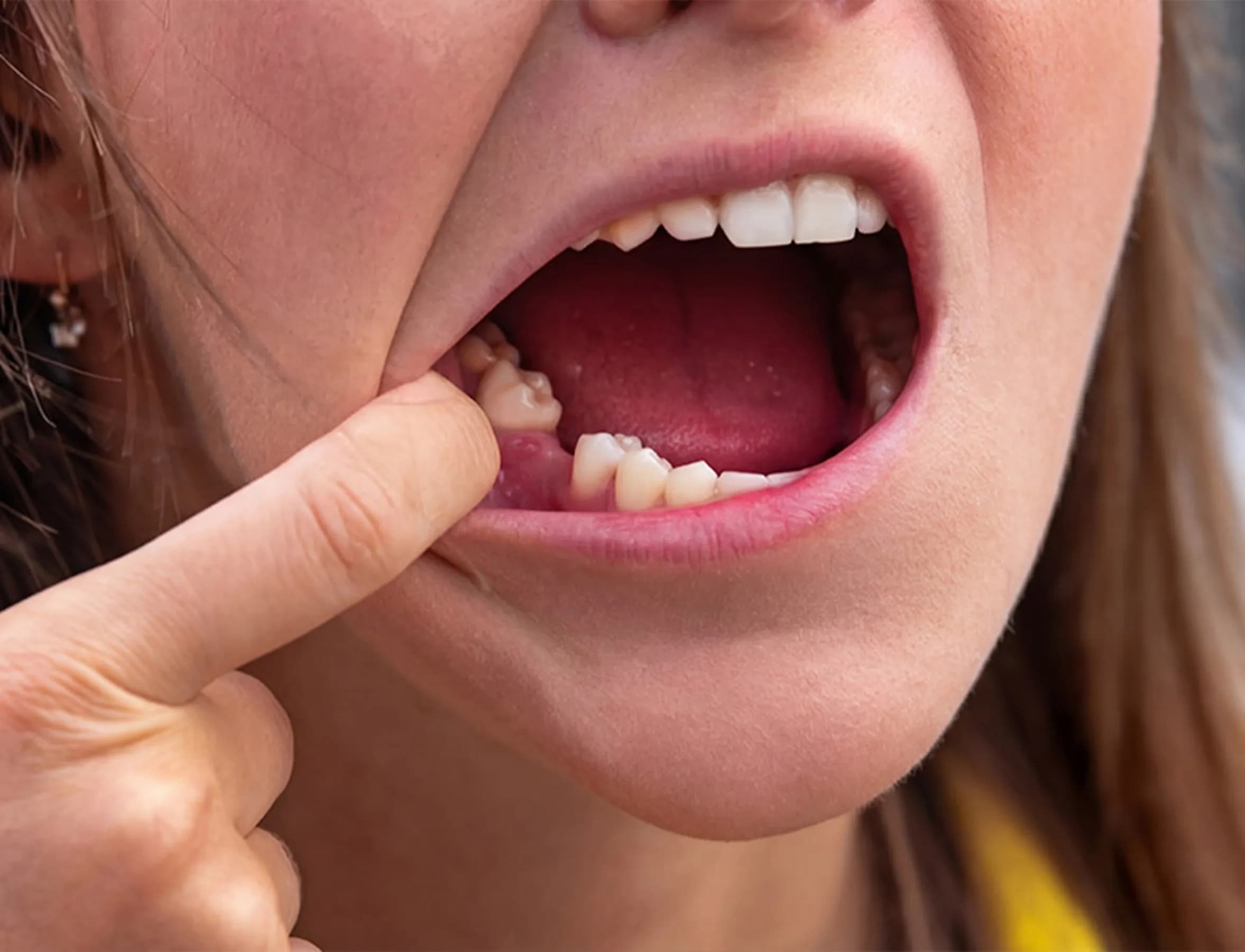 Dental implant model at Willow Family Dentistry