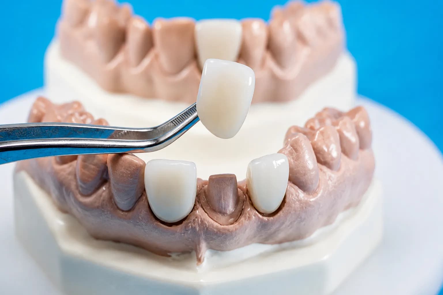 Dental Fillings